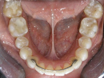 Invisalign after 273892
