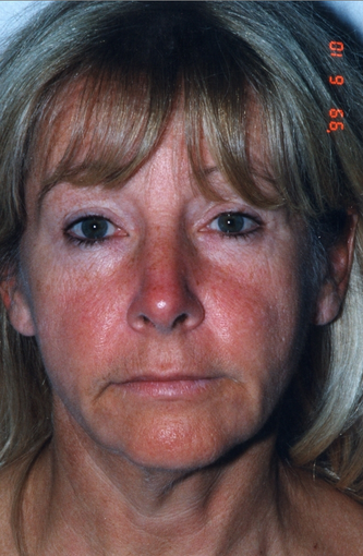 Skin Care before 531622