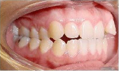 Invisalign Treatment before 359152