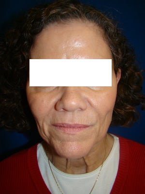 Neck and Face Lift Surgery before 157485
