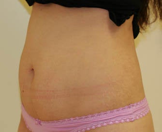Abdominoplasty (Tummy Tuck) before 216665