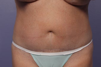 CoolSculpting to Abdomen before 429653