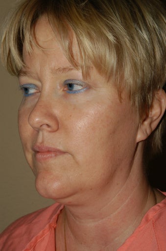 RefresherFacelift w/Neck Plication, Browllift, Fat Injections to Cheeks & Lips before 252901