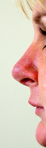 Revision Rhinoplasty after 578318