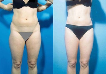 Liposuction before 636189
