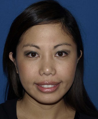 Revision Rhinoplasty with Chin Implant after 283303