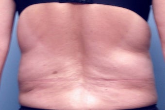 Slim Lipo before 137500