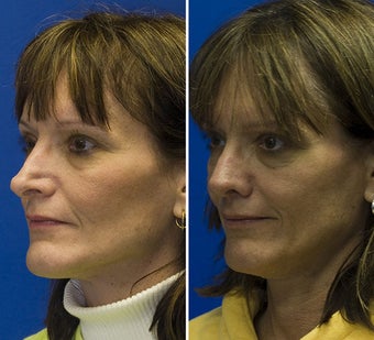 Revision Rhinoplasty after 295349