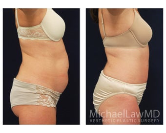 Tummy Tuck with Liposuction 391629