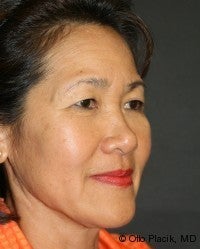 Neck Lift after 567432