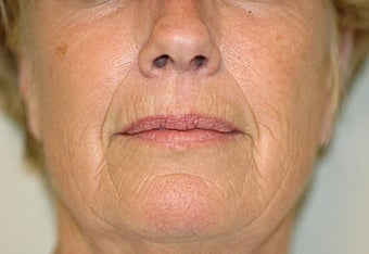 Before and Resurfacing Coblation Skin Resurfacing before 65325