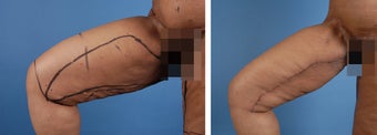 Thighplasty 303693