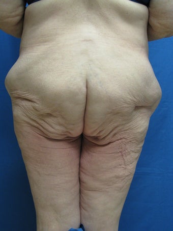 Circumferential Body Lift 364633