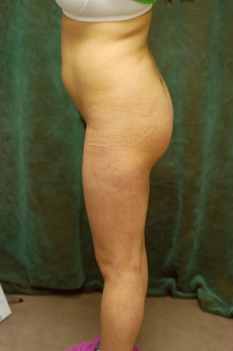 Women's Buttocks Augmentation after 518112