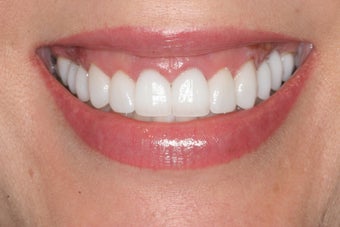 Smile Makeover: Porcelain Veneers after 94818