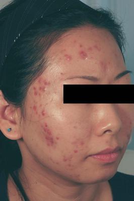 Laser Acne Treatment before 82971