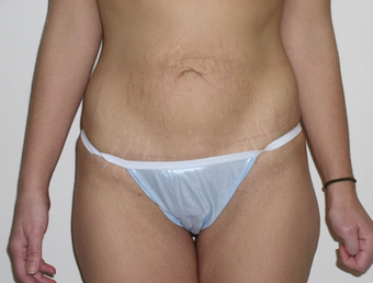 Tummy Tuck before 410415