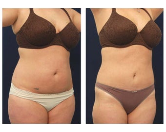 Liposuction after 397041