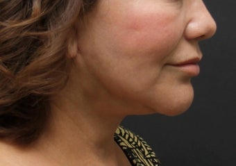 Facelift, Neck Lift, Lipocontouring of Neck after 414152
