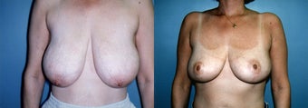 Breast Reduction & Mammoplasty before 348006