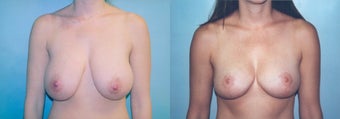 Breast Reduction using Inverted T incision before 352710