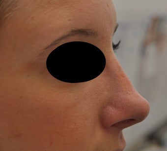 Non-surgical rhinoplasty before 182426