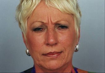 Botox Injection before 253128