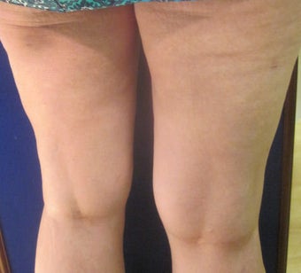 Cellulaze 589900