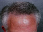 Hair Transplant after 426678