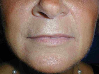 Juvederm to upper lip before 108815