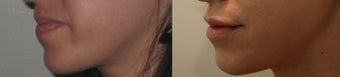 Lip Enhancement 450121