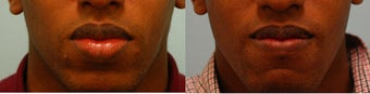 Lip Reduction/Lip Correction before 136721