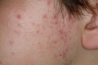 Laser Acne Treatment before 86809