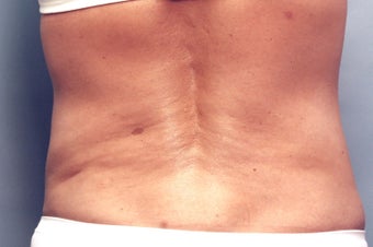 Slim Lipo after 137500