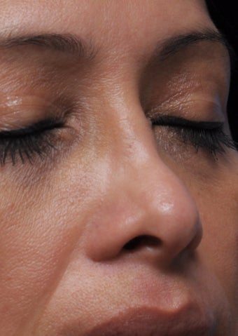 Non Surgical Rhinoplasty before 407855
