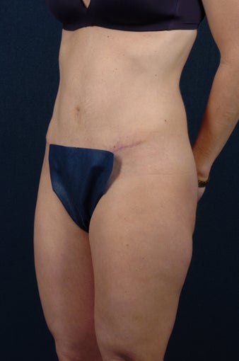 Abdominoplasty-Float after 267664