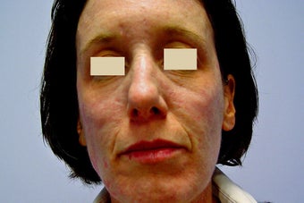 Fraxel Restore Treatment of Acne Scarring before 152212