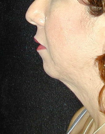 Chin Surgery before 101321