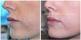 Juvederm: Subtle Lip Enhancement after 355964