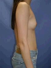 Breast Augmentation 356554