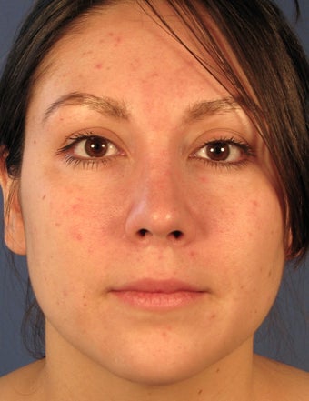 Revision Rhinoplasty after 410615
