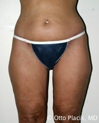 Thigh and Buttock Lift after 566621