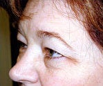 browlift and upper eyelid surgery before 84478