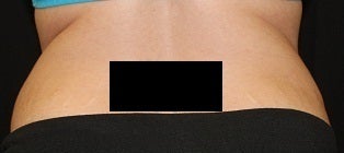 Coolsculpting - Flanks before 445740