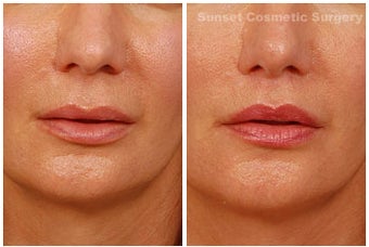 Lip lift before 355955
