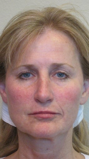 Sculptra and juvederm 582244