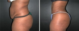 Buttock Augmentation before 110113