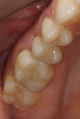Replacing Old Silver Fillings With Porcelain Fillings after 94812