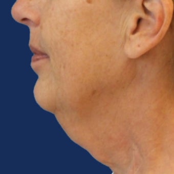 Lower Facelift and Necklift with Platysmaplasty before 243445