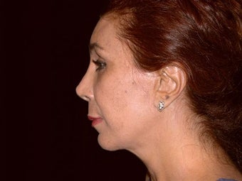 Face lift, brow lift, eyelid lift after 251755